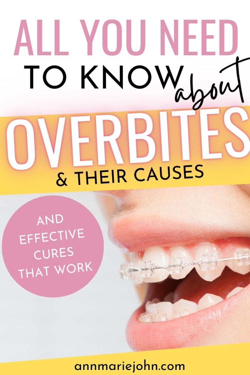 All You Need To Know About Overbites And Their Causes And Effective Cures That Work Annmarie John