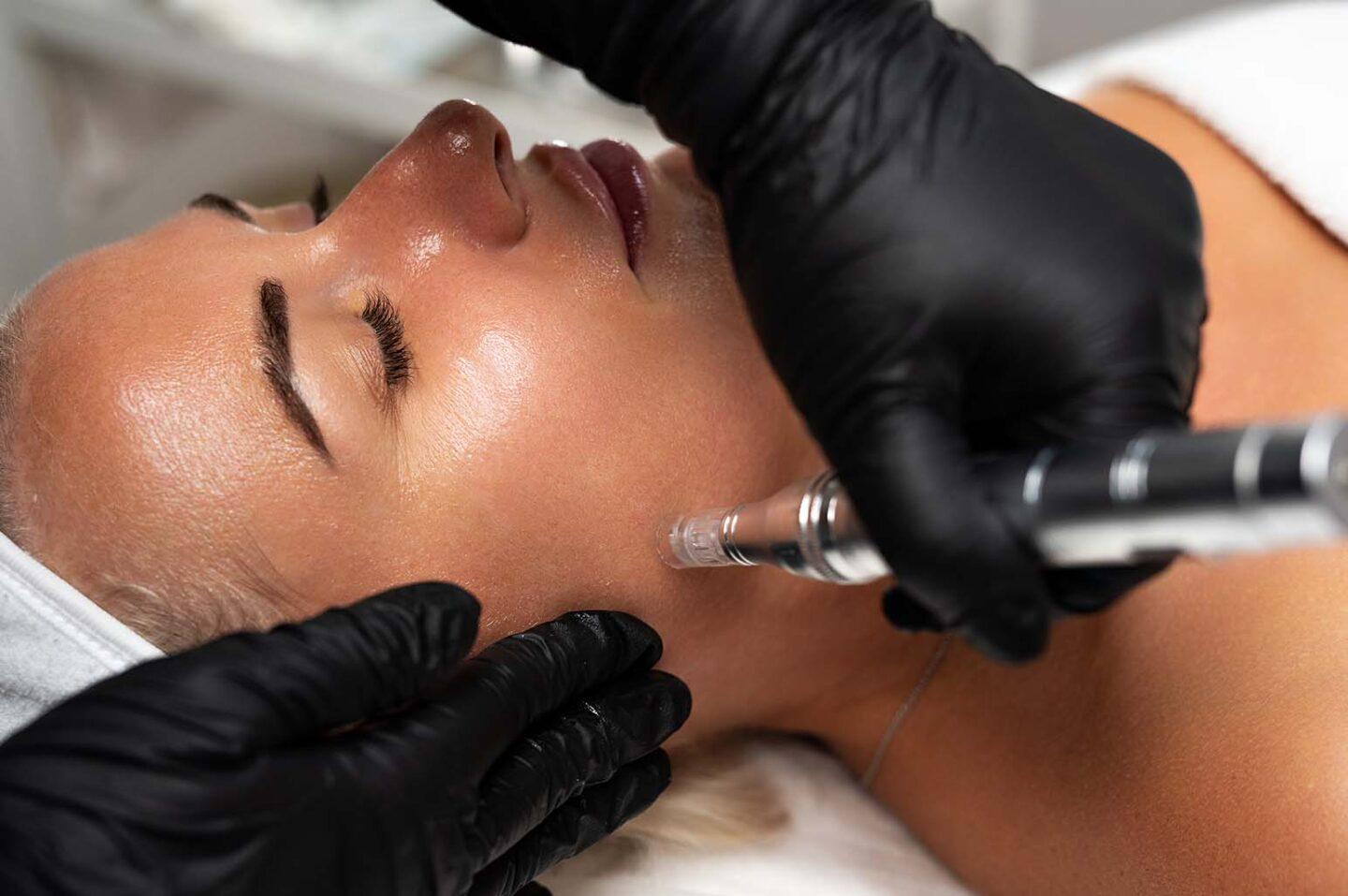 Microneedling